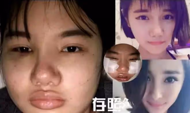 7年前,那個把自己整容成「真人芭比」的網紅迪麗拉如今後悔嗎?