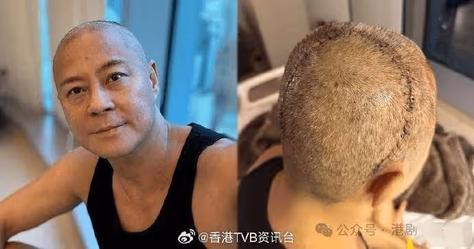 蔡一傑順利完成切除腦部腫瘤手術:相信往後人生更精彩