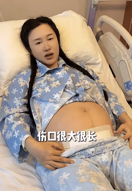 張紀中媳婦直呼剖腹產太疼了，傷口很大很長，母乳不足孩子吃不飽