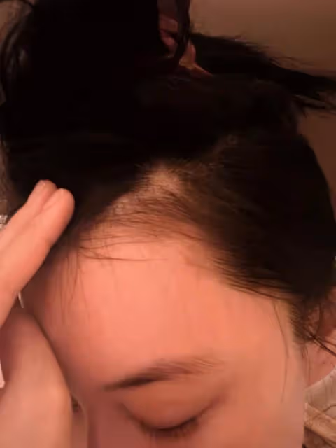 張馨予西藏拍戲出現斑禿,稱經常嘔吐睡不好,精神身體壓力過大