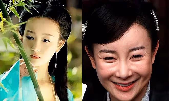 取出假體,她的臉又美回來啦!
