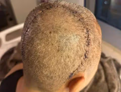 香港男歌手上月開腦切除腫瘤,哥哥透露其近況: 變靚仔才跟大家見面