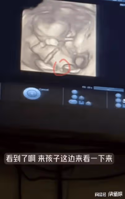 張檬去香港產檢!B超照曝光懷的是男孩,脫鞋測體重拇外翻好嚴重
