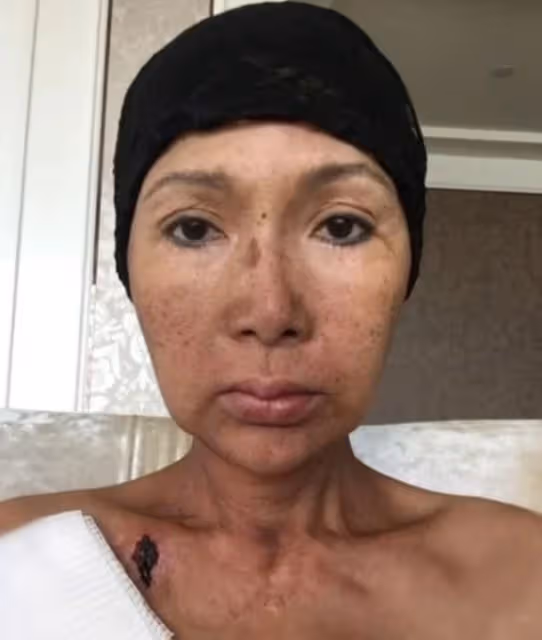 太慘!歌手張咪確診第3種癌症,將切掉一半舌頭,本人崩潰曝細節
