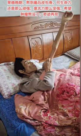 百萬抗癌網紅「年僅53歲離世」!湘妹子生前暴瘦剩35kg 兒慟:沒媽媽了