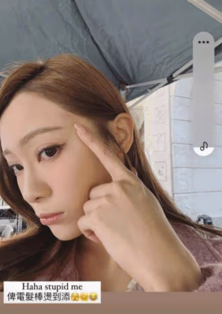 TVB性感小花自爆入行8年戶口僅2位數！直呼還沒用愧對家人！早前又燙傷額頭紅腫一大片