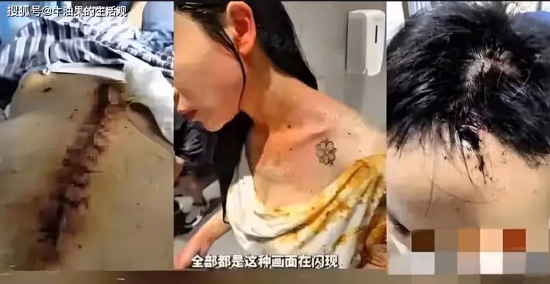 2年被家暴16次,終生掛糞袋女子發聲:願意凈身出戶,只接受死刑