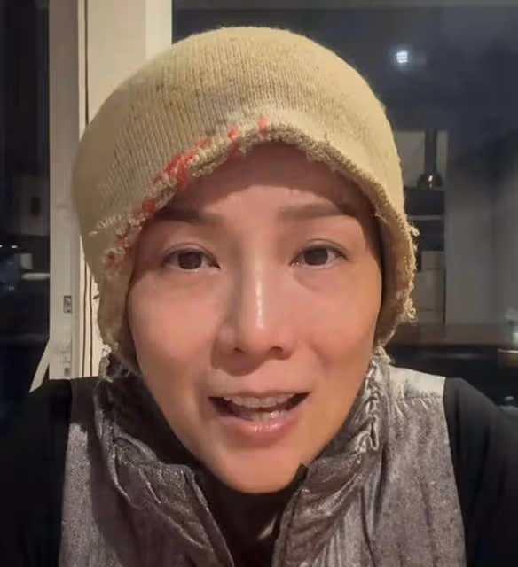 香港女星乳腺癌復發,順利完成細胞免疫治療,經常以光頭形象示人