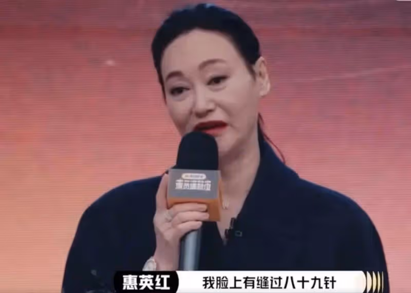劉梓晨承認整容熊乃瑾忙否認!惠英紅因受傷面部縫89針