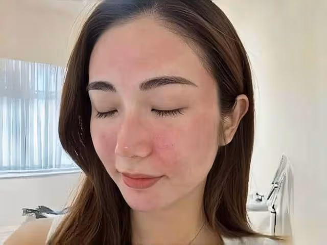 TVB前女星整容醫美長達十年,踏入娛樂圈不自信,打過六種美容針