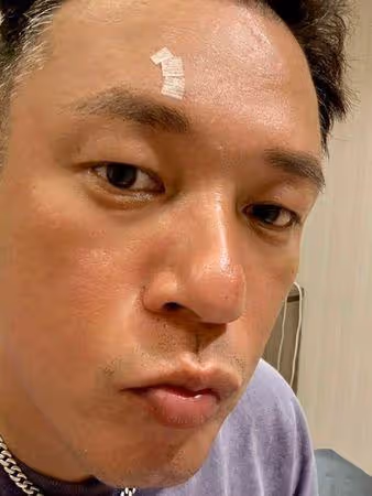 阿Ben拍戲受傷「白衣全是血」! 首曝傷勢照頭縫數針