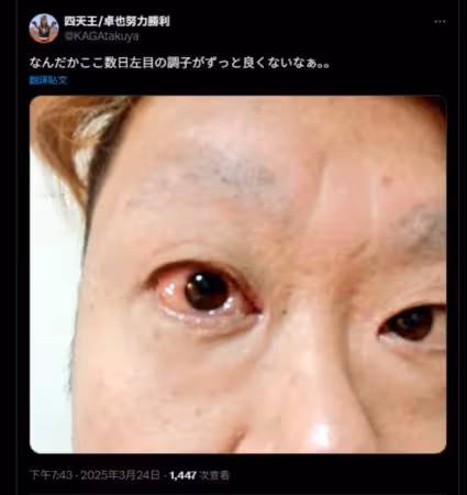 38歲日諧星腦幹梗塞逝世!生前PO左眼出血照…憂心吐:狀態不太好