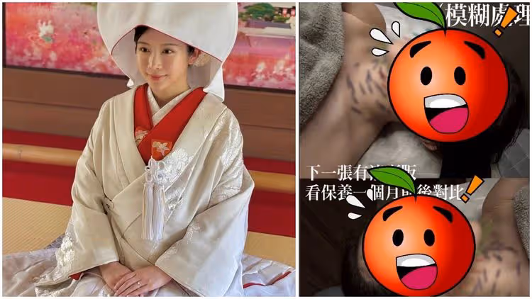 鄭家純依偎Akira拍結婚照　背地裡「臉插百針」瘀青！看了心驚