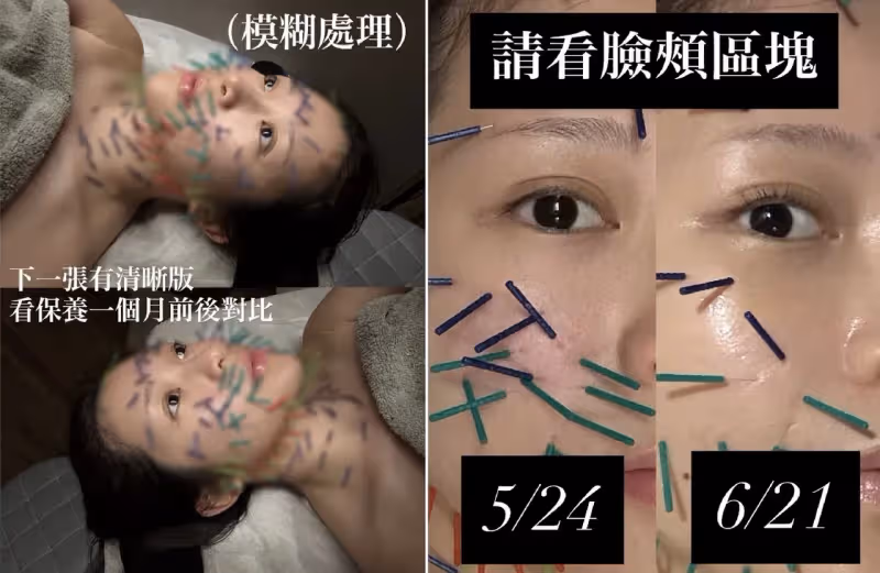 鄭家純依偎Akira拍結婚照　背地裡「臉插百針」瘀青！看了心驚