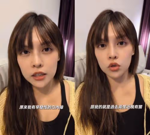 夏宇童36歲被診斷出「早發性白內障」 醫曝3原因:真的很震驚…