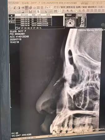 「鼻骨骨折」超慘傷照曝光! 《星光》張涵雅被兒子頭撞:沒想到