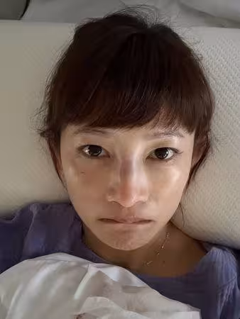 「鼻骨骨折」超慘傷照曝光! 《星光》張涵雅被兒子頭撞:沒想到