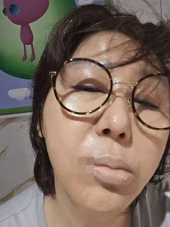 藍心湄突長「臭嘴角」泄身體警訊! 素顏照網急:快去看醫生