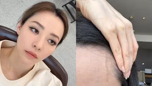 張靚穎健康亮紅燈!伸懶腰就滲血 額頭詭異突一條「查不出原因」