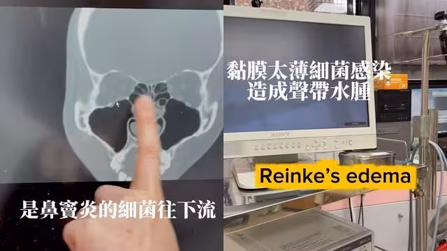 Albee驚傳完全發不出聲音！　「失聲狂灌鹽水」醫一看傻眼
