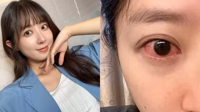 洪詩坐月子驚傳「角膜糜爛」! 眼睛劇紅近況曝光:真的要聽話