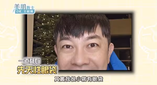 50歲李明川「動刀改善除眼袋」驚人成果曝光！　認昔被擊垮：看起來好可憐