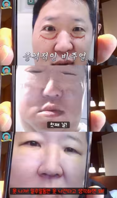 韓男星坦承整形！術後腫到不行「像被暴打」　眼睛慘剩一條縫