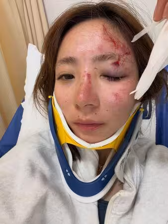 iPhone救了她的命！日女偶像國道車禍「滿臉血」偵測倒數叫救護車