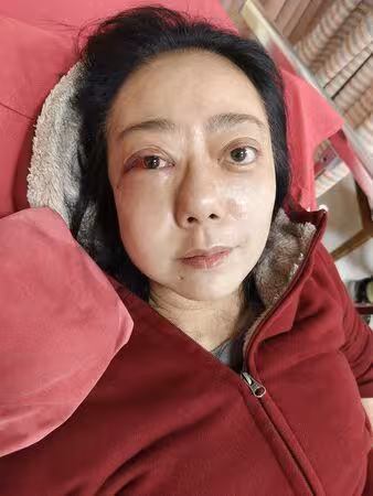 高慧君暴瘦24kg!在家昏倒臉骨折…整顆頭腫脹「1部位」永遠消失
