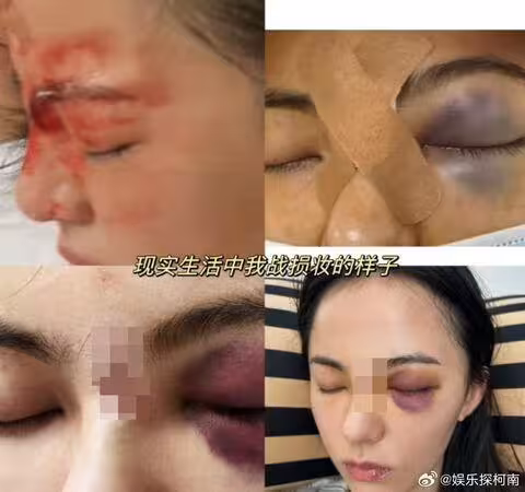 陸劇女神受傷「臉縫7針」遭換角!傳改拍短劇…網挺:直接短顏一