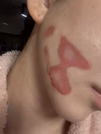 女星打音波出事！睡起來毀容：皮膚層層撕開捲起⋯　流膿傷照曝光