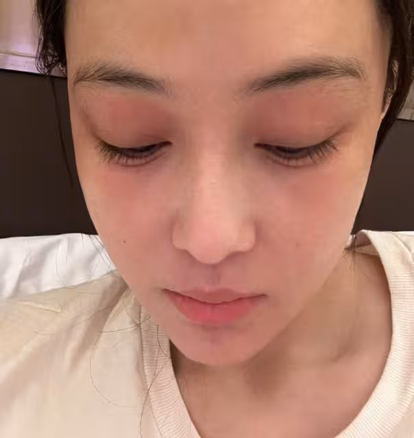 楊冪險遭蒸汽眼罩毀容！　傷照曝光…她警告：是低溫燙傷