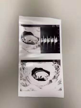 前Apink洪瑜暻宣布當媽！　結婚3年喜曬超音波照