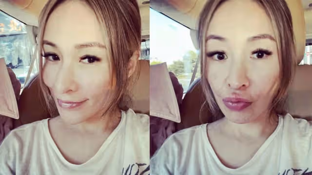 不遮了！蕭亞軒素顏「狗咬傷右臉」疤痕現形