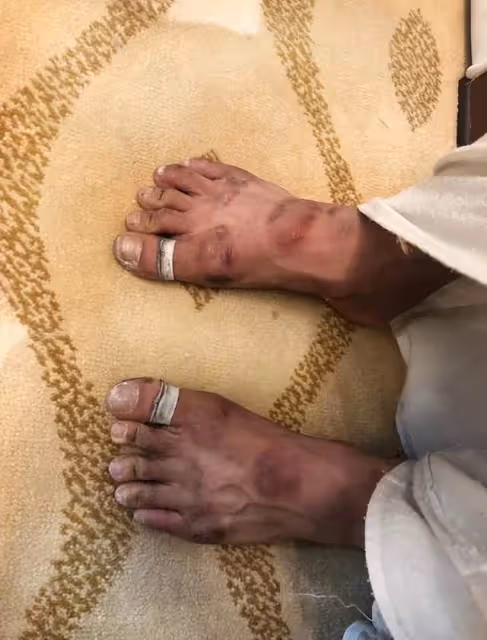 63歲楊麗萍太敬業！指甲折斷後右眼再受傷，纏紗布上台謝幕引熱議