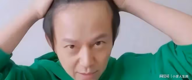 明星也有禿頭煩惱?黃曉明的假髮套,趙麗穎的脫髮煩惱說明一切