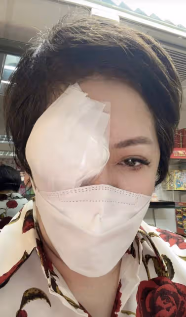 向太雙眼嚴重受傷!厚紗布遮半張臉血絲可怖,否認兒子出軌仍遭罵