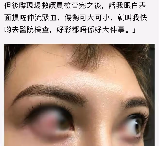 31歲港星被燈砸破頭!血流滿面衣領被染紅,緊急送醫後仍堅持拍戲