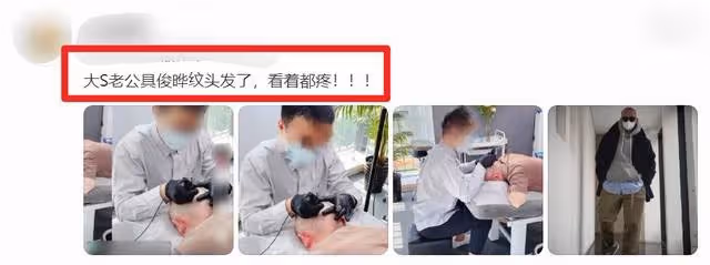 大S老公具俊曄去紋「頭髮」畫面曝光,一針一針紋在頭上,看著就疼