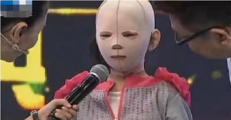 10歲女孩整天帶著「頭套」，同學都嘲笑她是「怪物」，摘下面具後眾人淚奔！