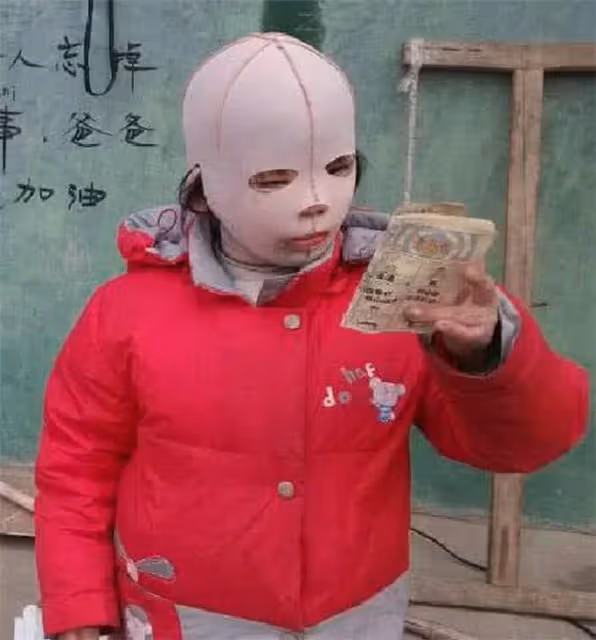 10歲女孩整天帶著「頭套」，同學都嘲笑她是「怪物」，摘下面具後眾人淚奔！