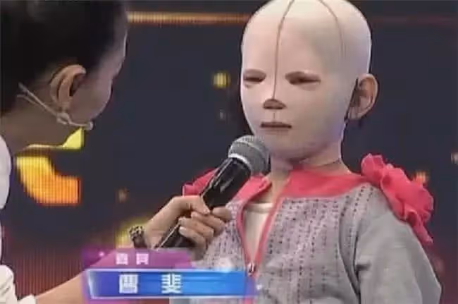 10歲女孩整天帶著「頭套」，同學都嘲笑她是「怪物」，摘下面具後眾人淚奔！