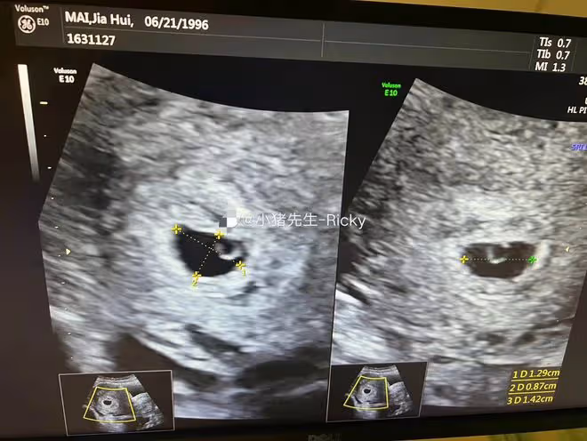 百萬粉網紅官宣二胎!辦婚禮僅1周女兒剛8個月,曾自曝想生兒子