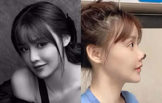 32歲女星承認整容!鼻子變歪一推就動需手術修復,曾經還全身抽脂