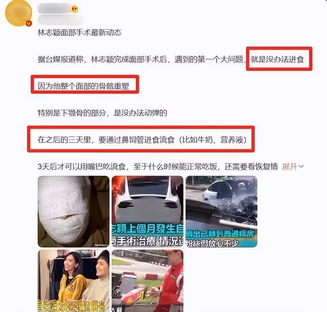 林志穎被曝面部纏滿紗布,術後會留下永久疤痕,目前進食靠鼻飼