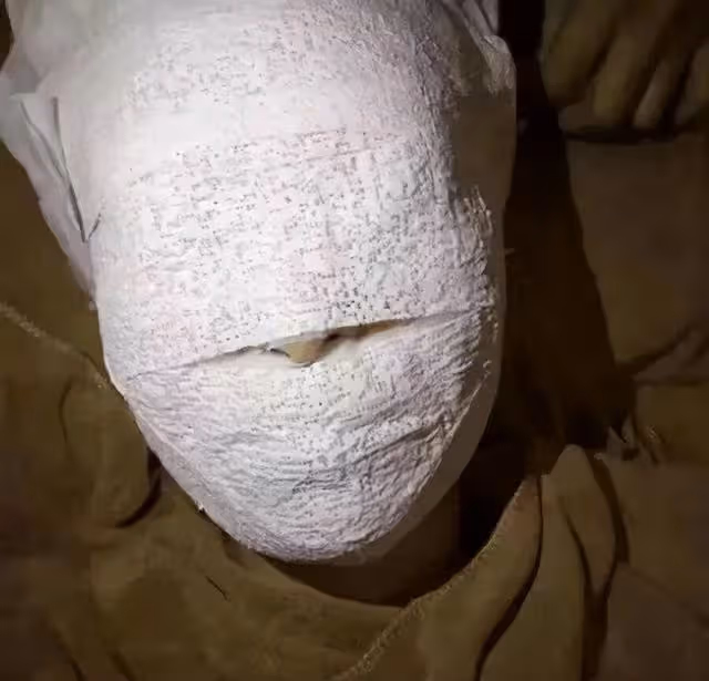 林志穎被曝面部纏滿紗布,術後會留下永久疤痕,目前進食靠鼻飼