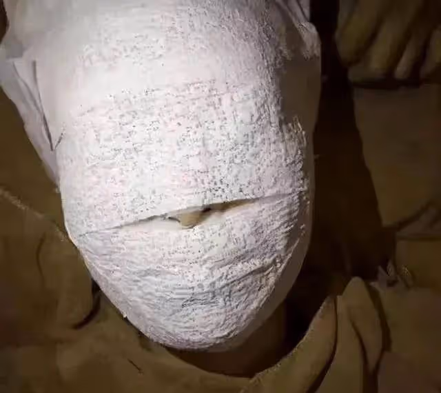 林志穎整容後狀態不佳，很難恢復以前的容貌，讓人想起胡歌的車禍