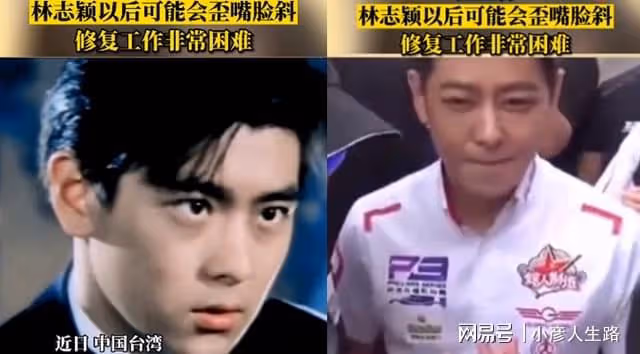 曝林志穎術後情況惡化,工作室回應引擔憂,以後可能會臉歪嘴斜