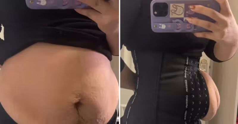 2胎都是雙胞胎，寶媽束腰扣不上看著妊娠紋無奈，網友心疼：做媽媽太不容易了