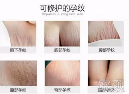 2胎都是雙胞胎,寶媽束腰扣不上看著妊娠紋無奈,網友心疼:做媽媽太不容易了